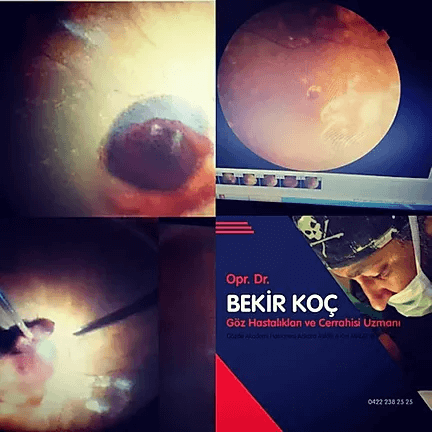 VİTREORETİNAL CERRAHİ